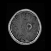 Brain tumor segmentation project thumbnail