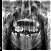 Dental x-ray AthiraMajinu project thumbnail