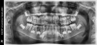 Panoramic Caries - BBox project thumbnail