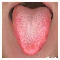 Tongue Tumor Detection project thumbnail