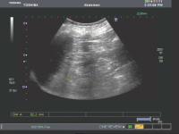 Kidney ultrasound segmetation 2 project thumbnail