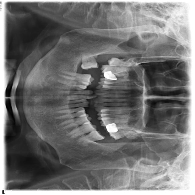 Oral Object Detection Model by Deep Learning Model Oral Cancer