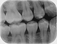 dental_caries_bitewing_Serkan_Hocam project thumbnail