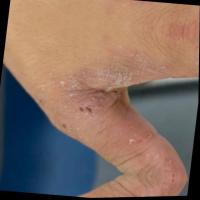 Skin DiseaseDetection project thumbnail