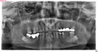 JAW CYSTS AI project thumbnail