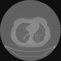 detecting lungs and heart project thumbnail