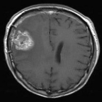 Brain Tumors Detection project thumbnail