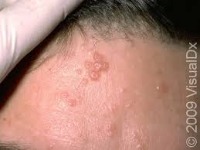 Skin desease project thumbnail