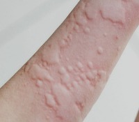 Skin desease project thumbnail