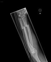 Oblique Fracture Annotation project thumbnail