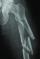 Bone type 3 project thumbnail