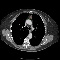 lung cancer demo project thumbnail