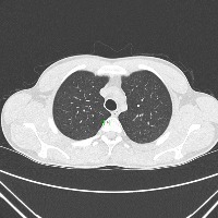 lung cancer demo 2 project thumbnail