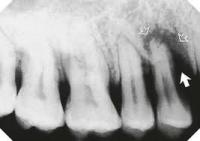 bone loss project thumbnail