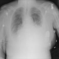 Effusion Chest X-ray project thumbnail