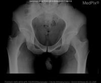 Tumor Bone project thumbnail