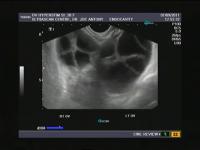 Follicle detection  project thumbnail