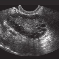 pcos project thumbnail