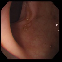 Polyp Detection project thumbnail