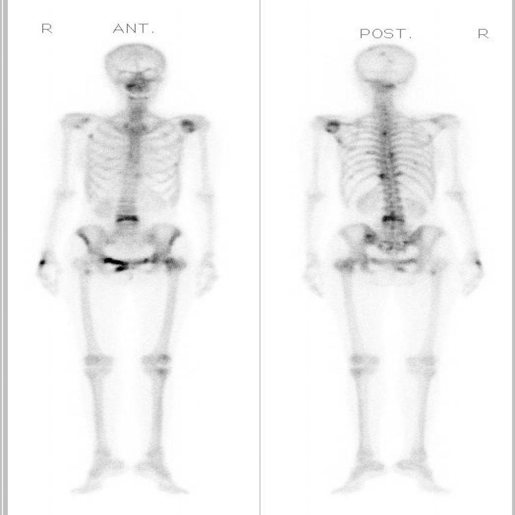 bone_tumer Object Detection Model by university