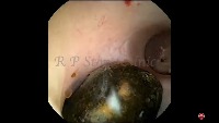 Kidney Stone Detection project thumbnail