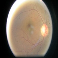 diabetic-ret project thumbnail