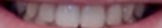 teeth1 project thumbnail