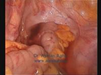 do laparoscopic left coloectomy project thumbnail