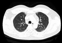 Wow lung cancer project thumbnail
