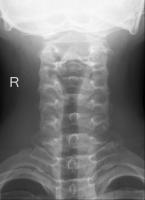 cervical-vertebrae-abnormality project thumbnail
