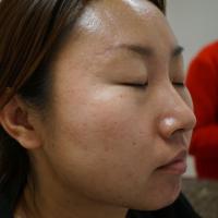 Acne Detection project thumbnail
