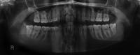Tooth_Cavity_Detection project thumbnail