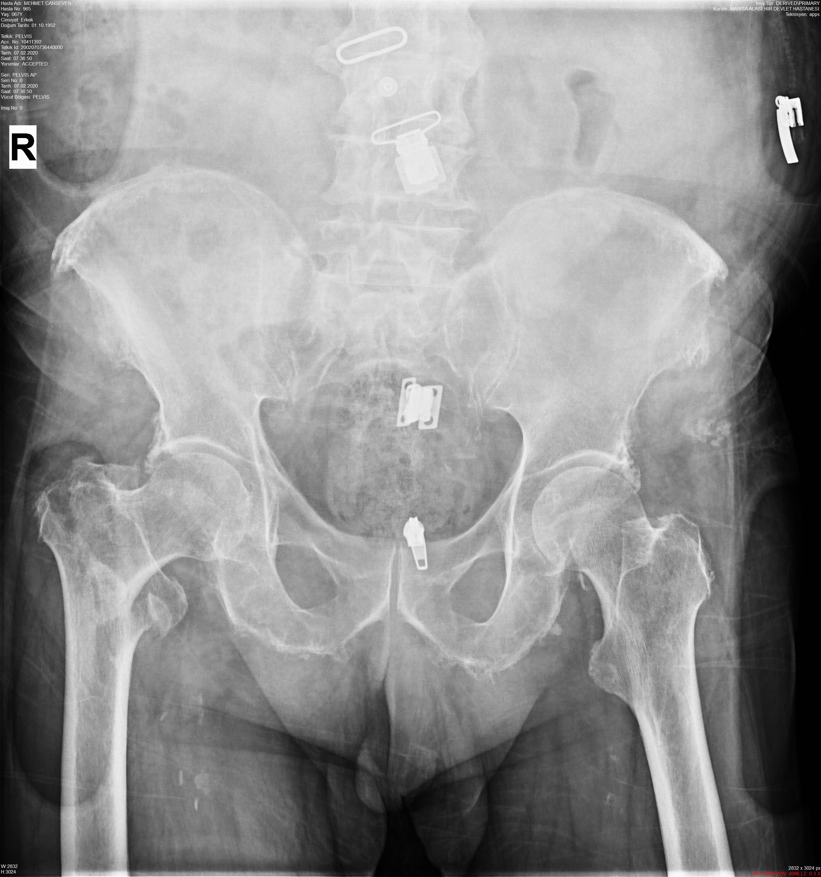 KALÇA FX Object Detection Dataset by TommyNgx