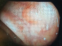 polyp1 project thumbnail