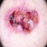 skin cancer project thumbnail