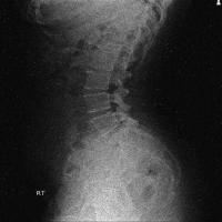 vertebra project thumbnail