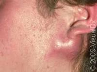 acne project thumbnail