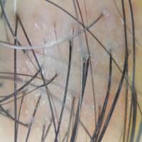 Hair_Follicle project thumbnail