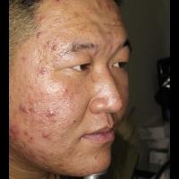 acne detect project thumbnail