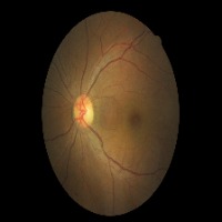 Diabetic Retinopahty 3.0 project thumbnail