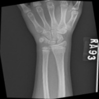 Upper bone detection  project thumbnail