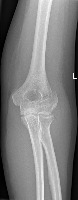 Bone Fracture Project project thumbnail