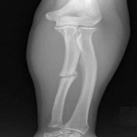 bone fracture project thumbnail