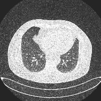 Lung Cancer Object Detection Model by PFE