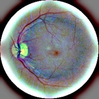 Fundus Classification Dataset by Marmara University