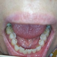Teeth Detection project thumbnail
