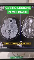 brain tumor detection project thumbnail