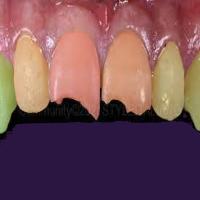 Test-Impacted Tooth project thumbnail