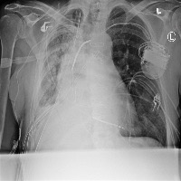 Pneumothorax Chest X-Ray Data project thumbnail