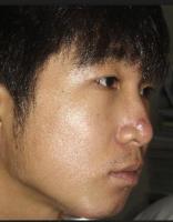 newacne project thumbnail
